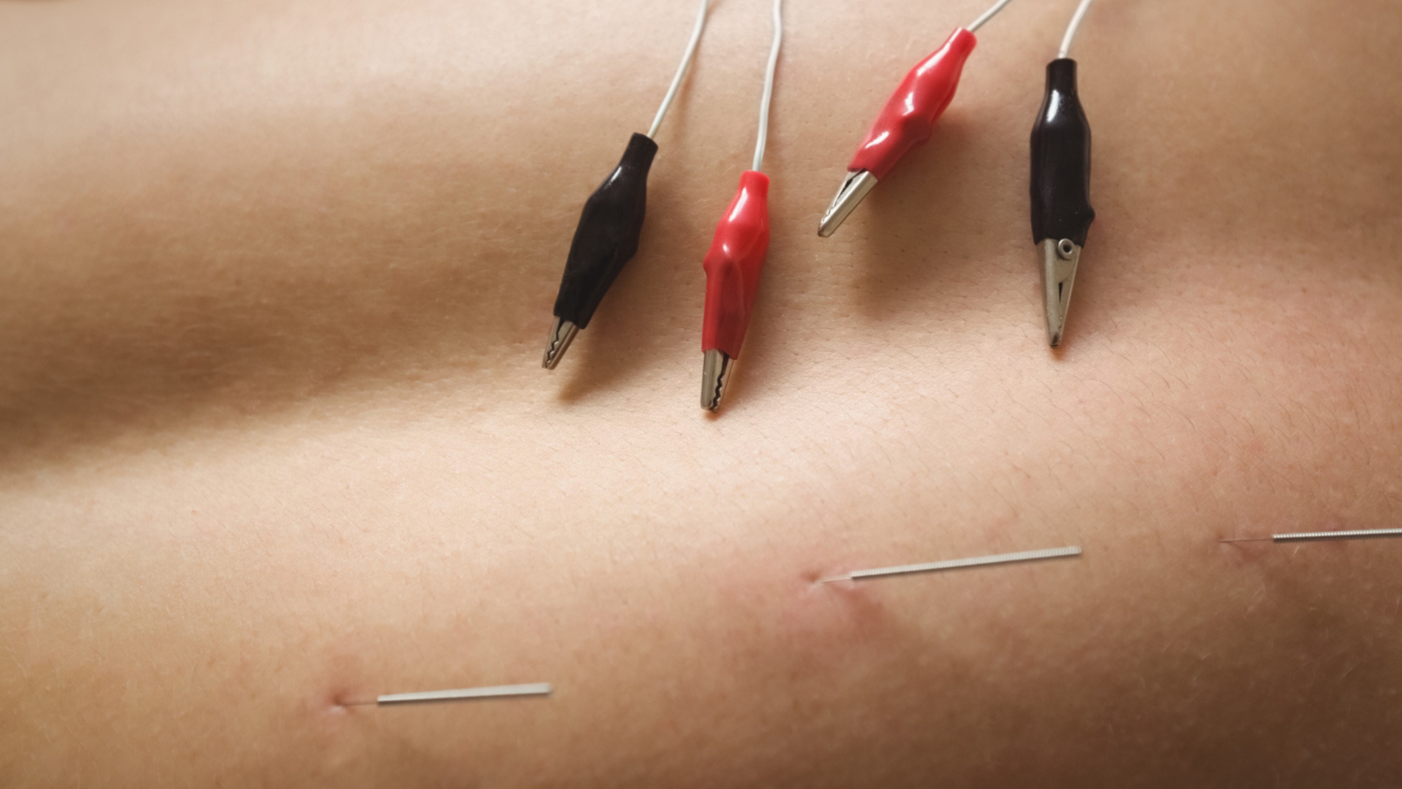 Dry Needling